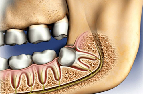 Oralkirurgi